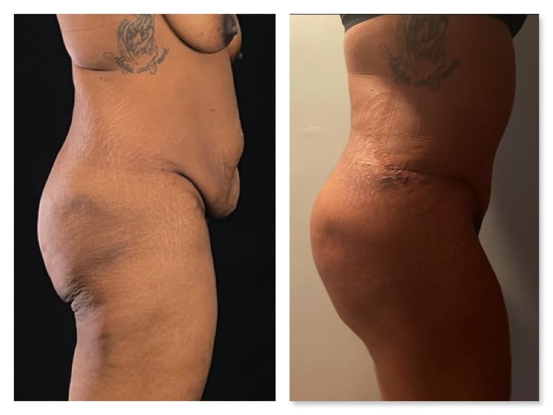 Brazilian Butt Lift Before & After Gallery - Patient 133183896 - Image 3