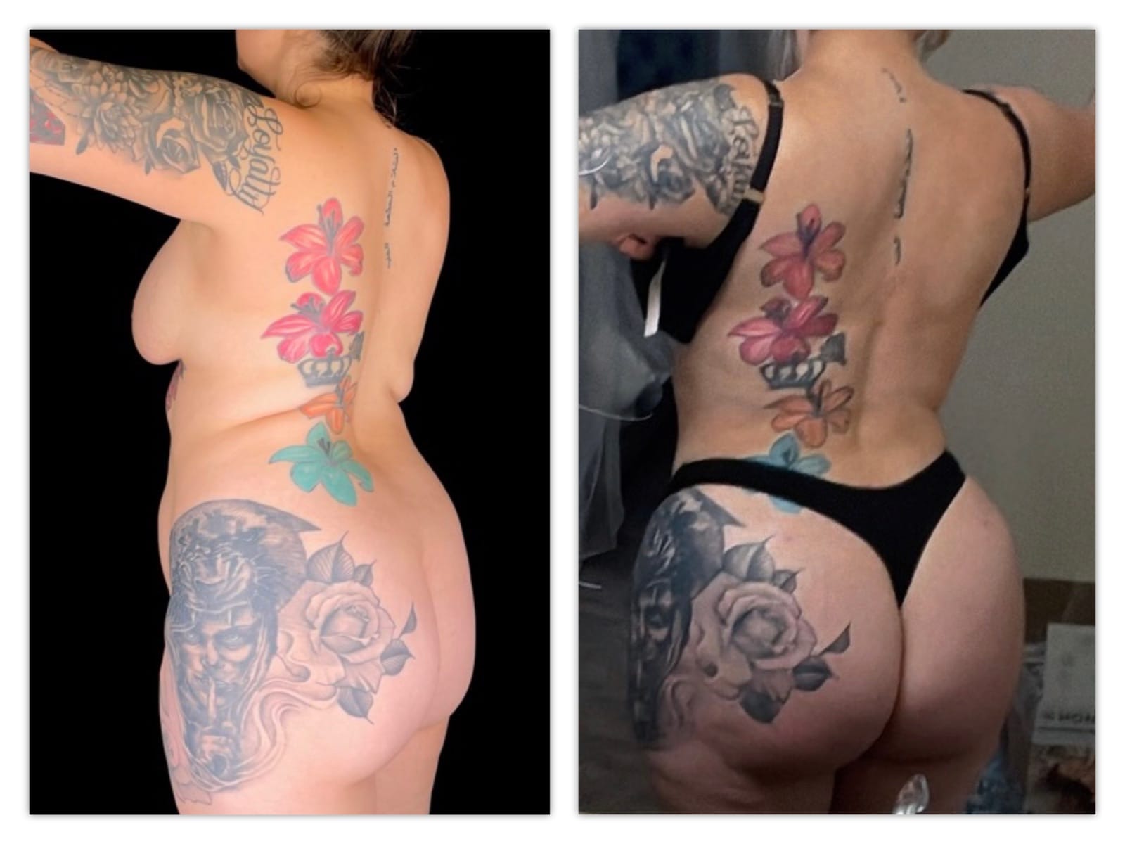 Brazilian Butt Lift Before & After Gallery - Patient 133183820 - Image 2