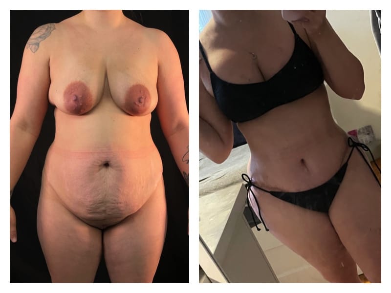 Mommy Makeover Before & After Gallery - Patient 133183868 - Image 1