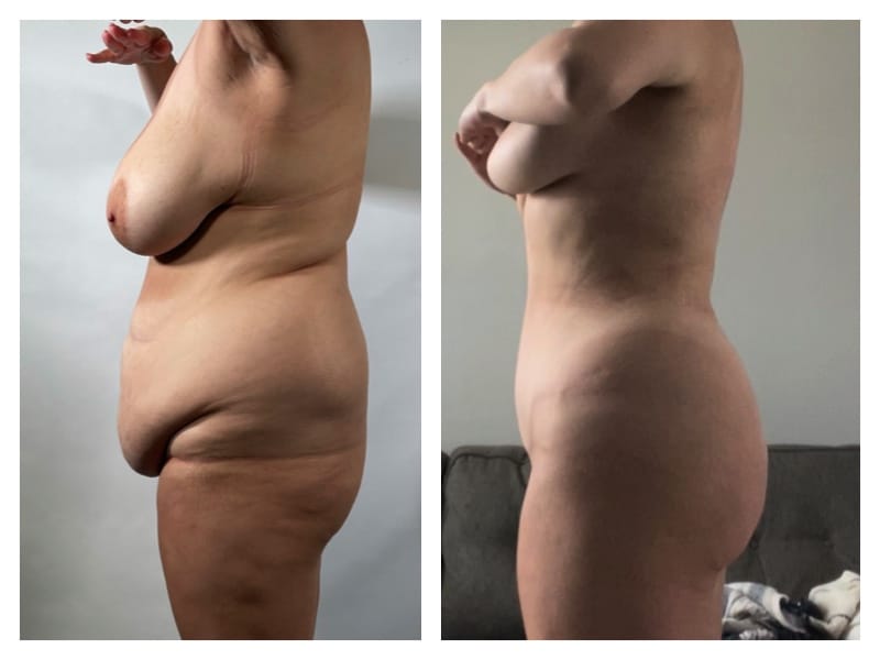 Brazilian Butt Lift Before & After Gallery - Patient 133183891 - Image 2