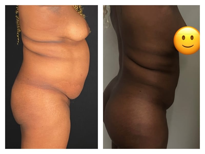 Brazilian Butt Lift Before & After Gallery - Patient 133183864 - Image 3