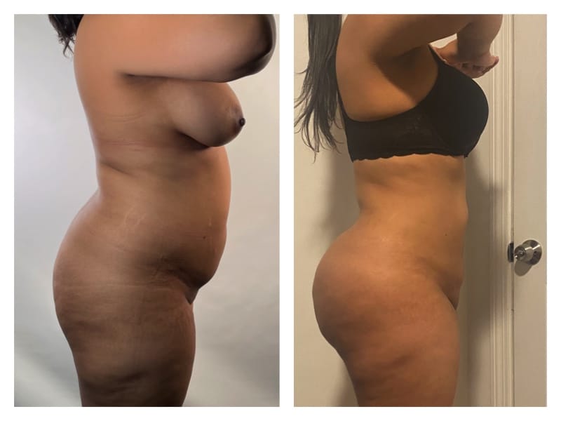 Brazilian Butt Lift Before & After Gallery - Patient 133183915 - Image 3