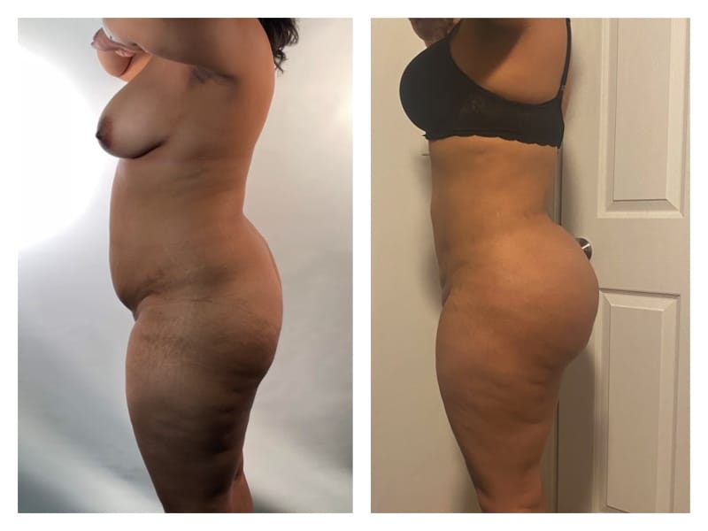 Brazilian Butt Lift Before & After Gallery - Patient 133183915 - Image 2