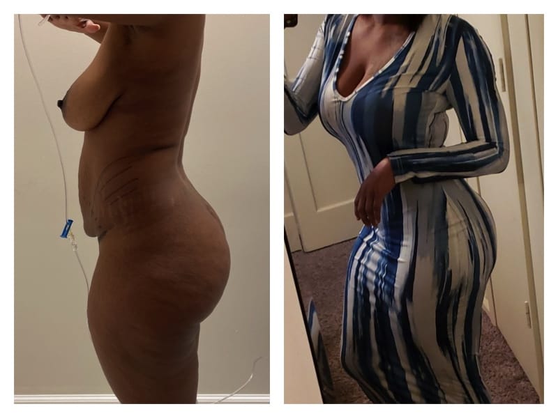 Tummy Tuck Before & After Gallery - Patient 133183929 - Image 4