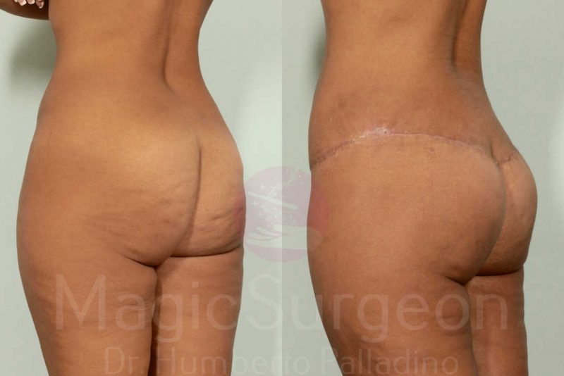 Brazilian Butt Lift Before & After Gallery - Patient 143542140 - Image 5