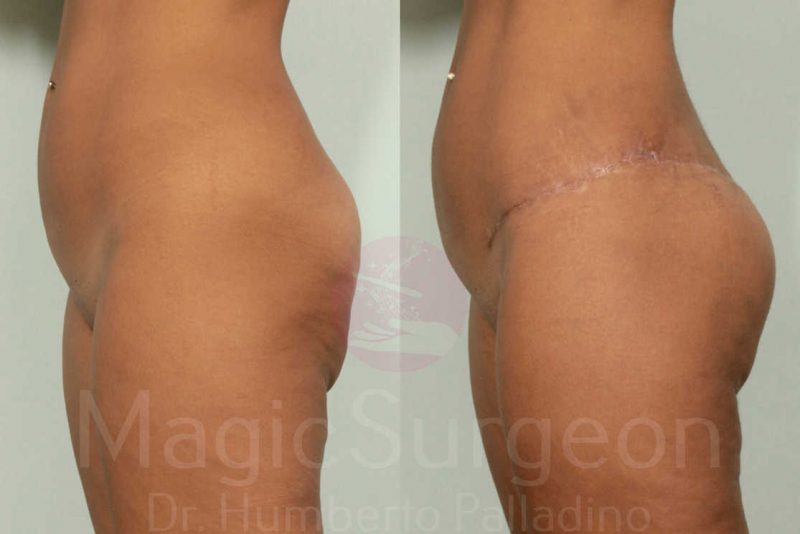 Brazilian Butt Lift Before & After Gallery - Patient 143542140 - Image 4