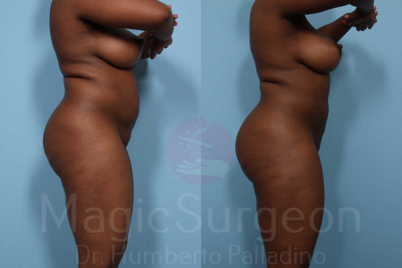Liposuction Before & After Gallery - Patient 133182310 - Image 5