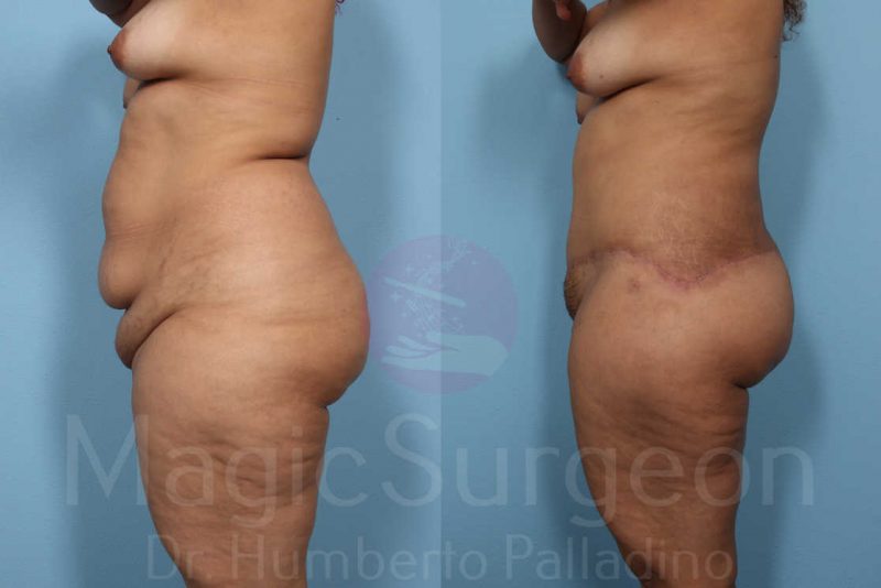 Tummy Tuck Before & After Gallery - Patient 133182339 - Image 3
