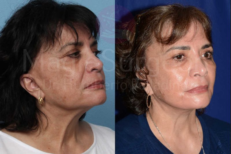 Neck Lift Before & After Gallery - Patient 133182378 - Image 4