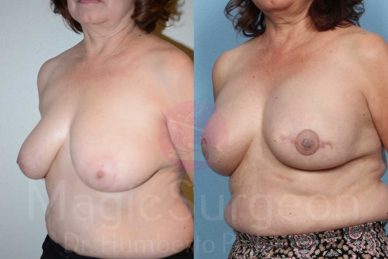 Breast Reconstruction Before & After Gallery - Patient 133182432 - Image 2