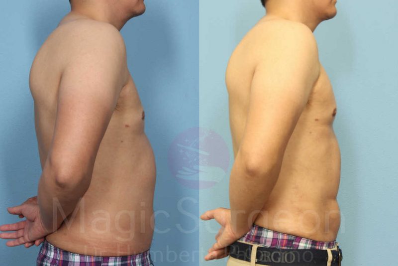 Male HD Liposculpture Before & After Gallery - Patient 133182470 - Image 5