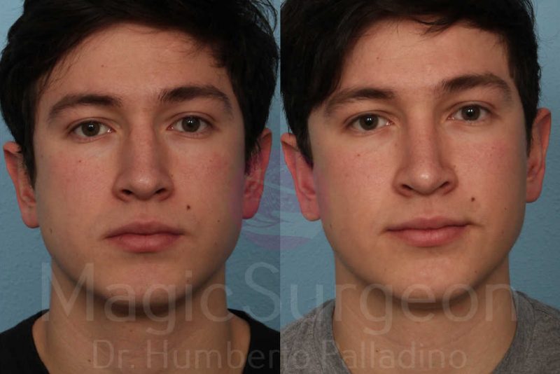 Men's Rhinoplasty Before & After Gallery - Patient 133182473 - Image 1