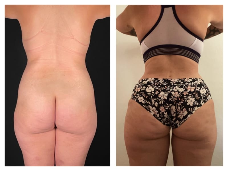 Tummy Tuck Before & After Gallery - Patient 133183638 - Image 2