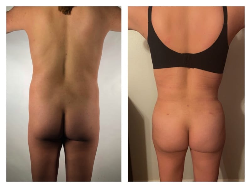 Mommy Makeover Before & After Gallery - Patient 133183667 - Image 2