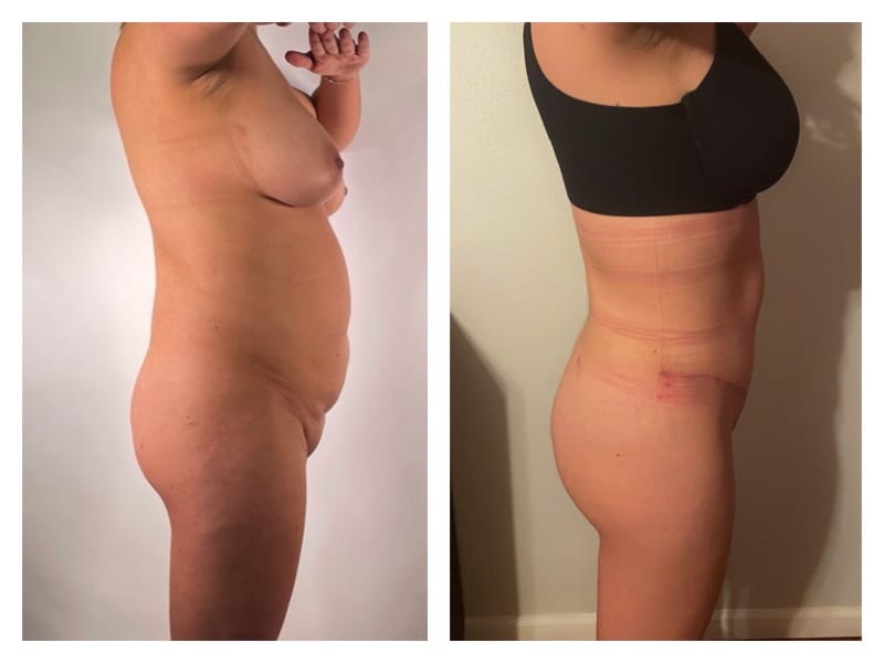 Mommy Makeover Before & After Gallery - Patient 133183667 - Image 3