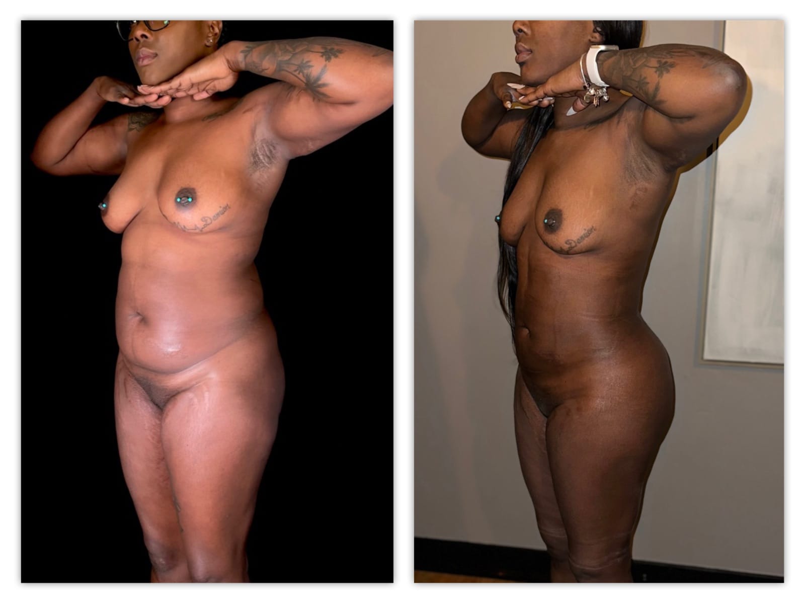 Brazilian Butt Lift Before & After Gallery - Patient 133183669 - Image 2