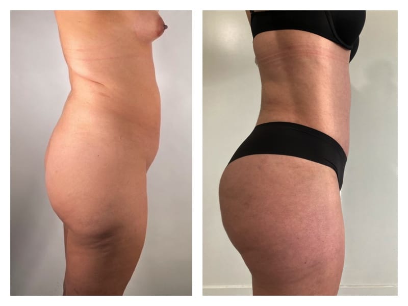 Brazilian Butt Lift Before & After Gallery - Patient 133183872 - Image 3