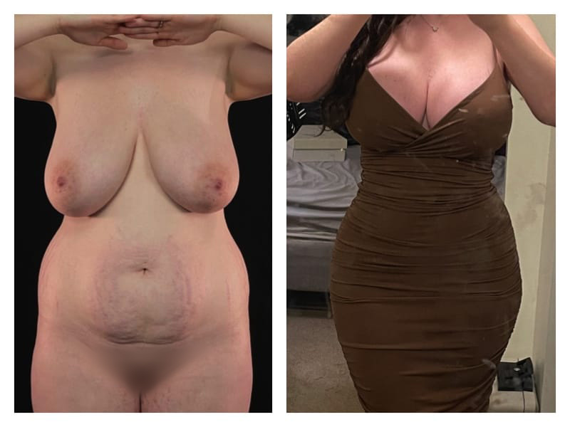 Mommy Makeover Before & After Gallery - Patient 133183839 - Image 5