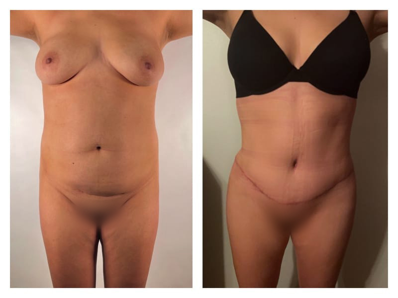 Mommy Makeover Before & After Gallery - Patient 133183667 - Image 4