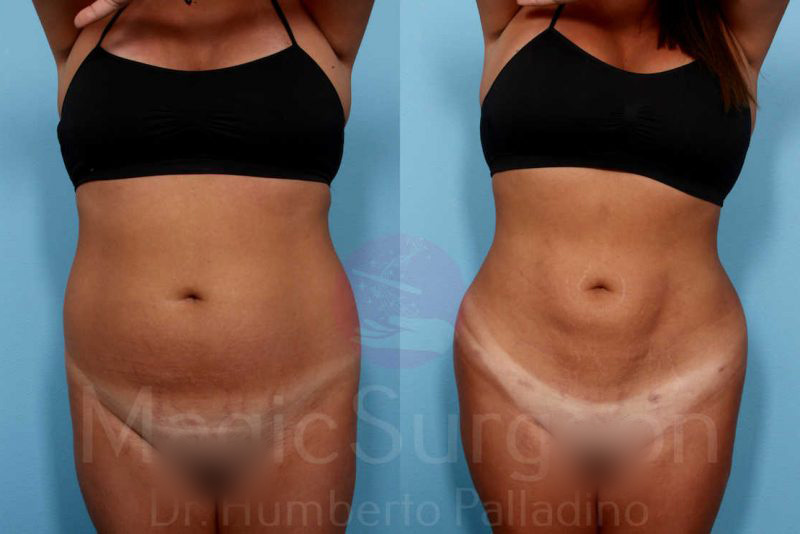Liposuction Before & After Gallery - Patient 133182333 - Image 3