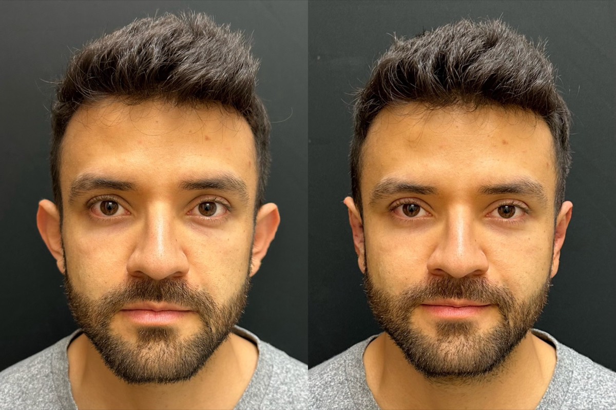 InstaEarFix ear correction before and after