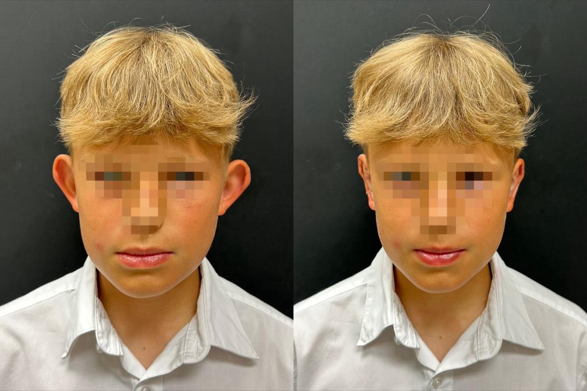 InstaEarFix ear correction before and after &mdash; patient age 16