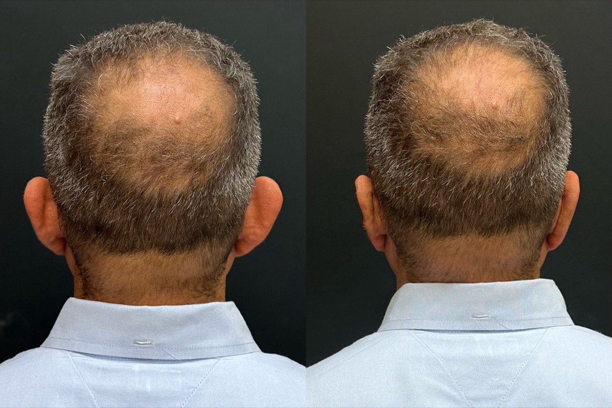 InstaEarFix ear correction before and after &mdash; patient age 42