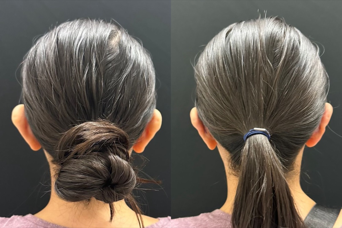 InstaEarFix ear correction before and after &mdash; patient age 28