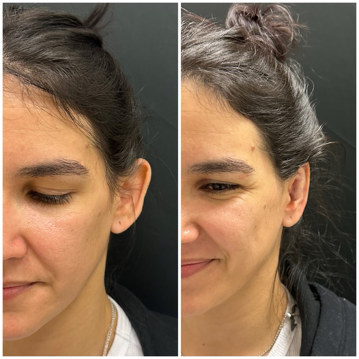 InstaEarFix ear correction before and after &mdash; patient age 33