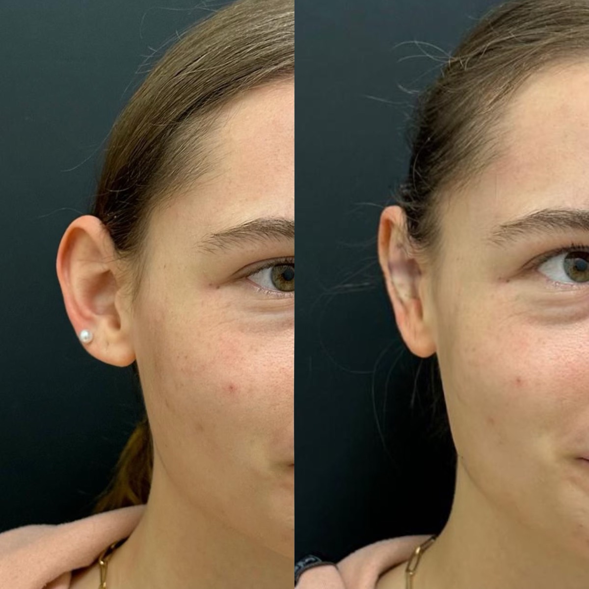InstaEarFix ear correction before and after &mdash; patient age 19