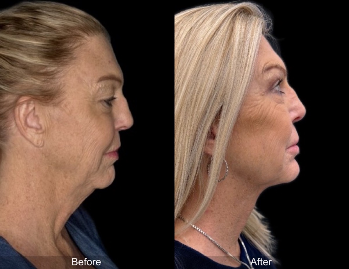 InstaFix Face before and after &mdash; 59-year-old patient, view 2