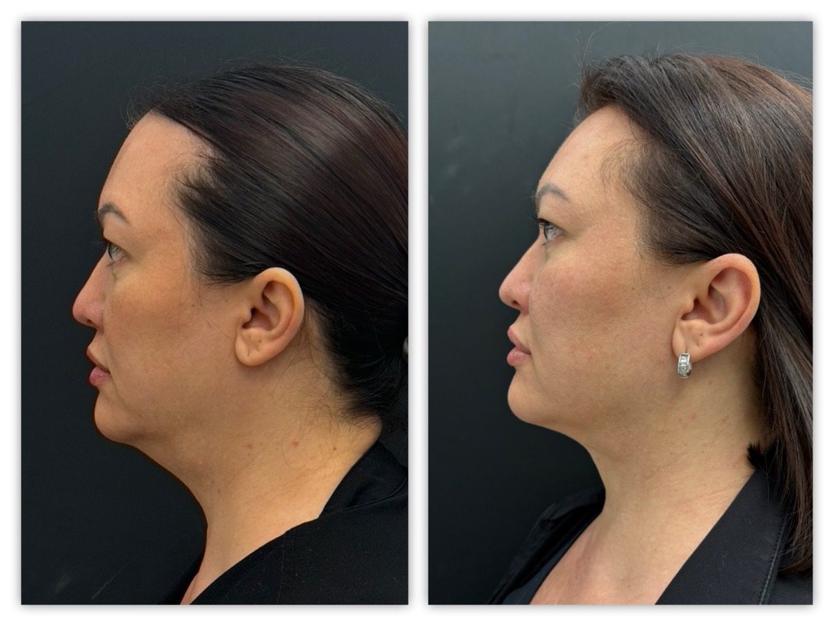 InstaFix Neck contouring before and after