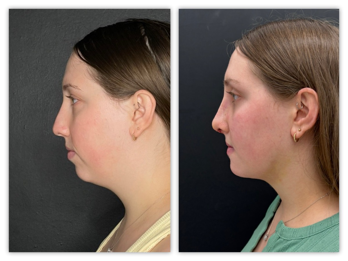 InstaFix facial profile refinement before and after &mdash; young patient, view 1