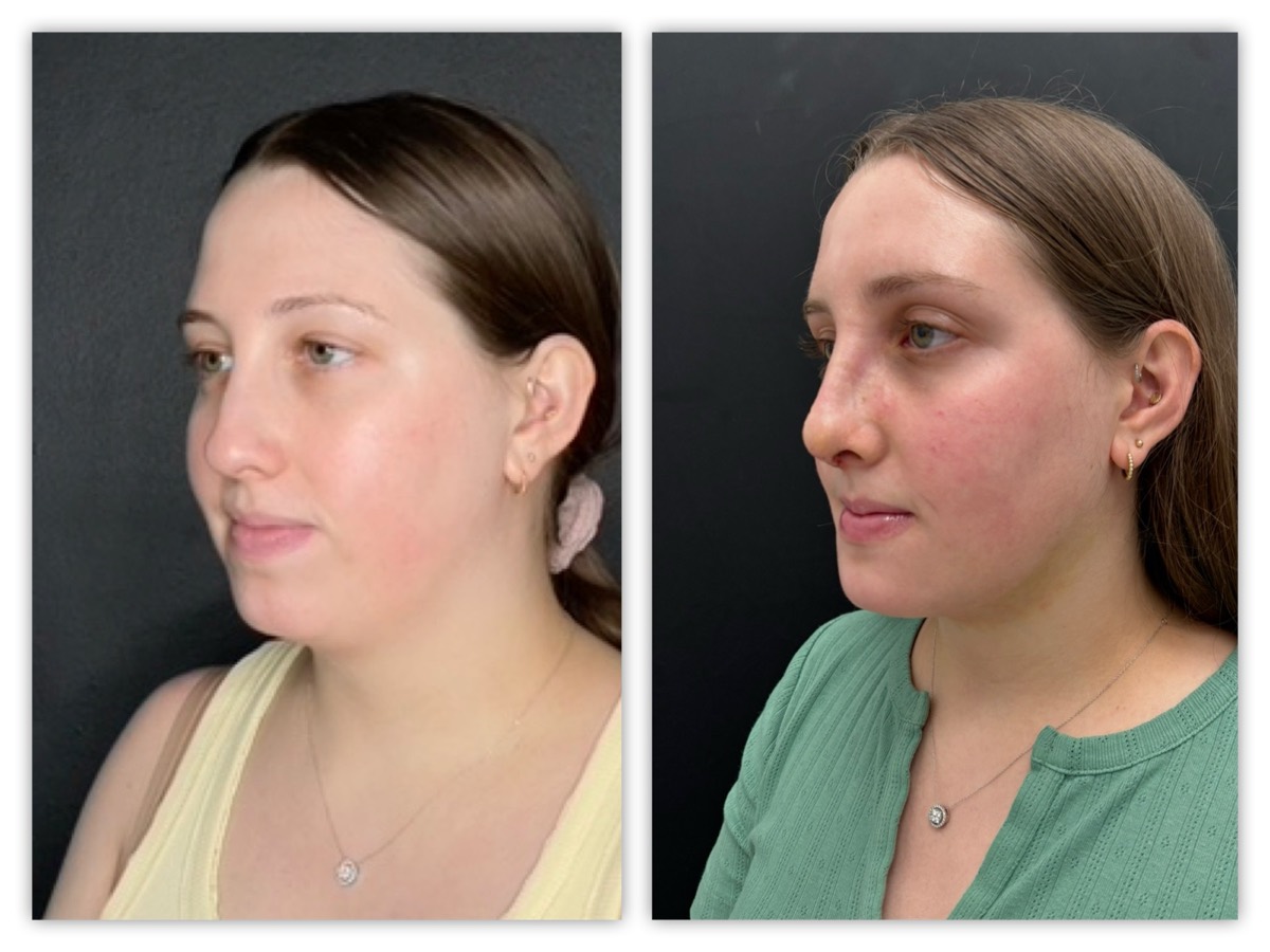 InstaFix facial profile refinement before and after &mdash; young patient, view 2